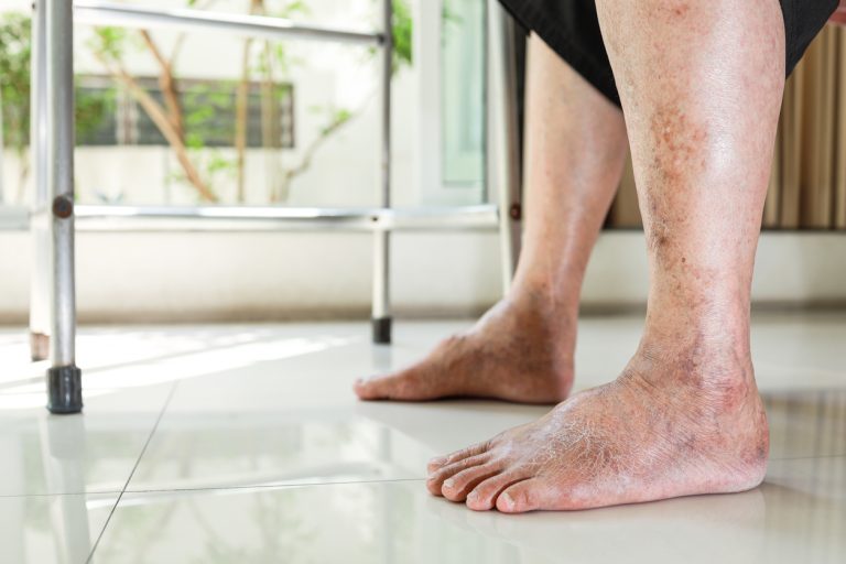 How Long Off Work After Varicose Vein Surgery