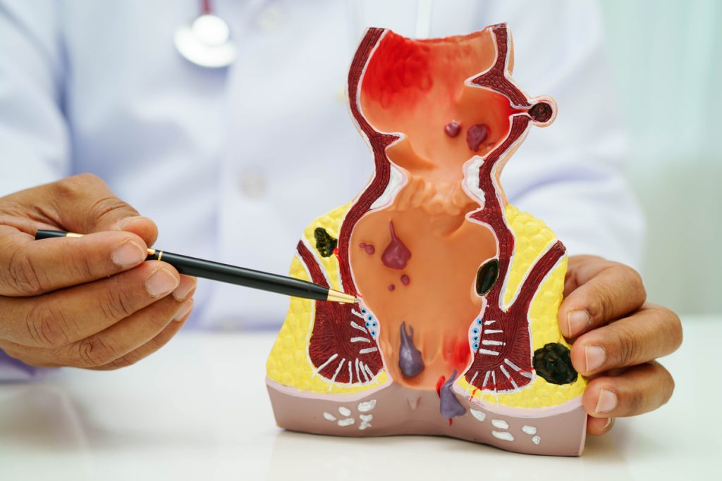 doctor with rectum and hemorrhoid human anatomy model at hospital, inflamed vascular structure.