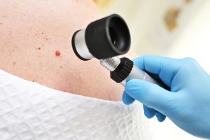 close-up - a dermatologist examines moles and skin growths on the patient's body using a special device - a dermatoscope. Diagnosis and prevention of melanoma.