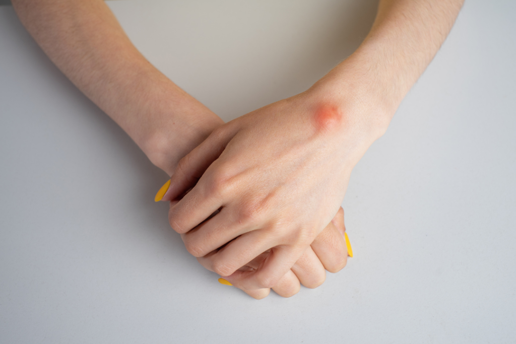 Is This a Lipoma or Something More? When to See a Surgeon lipoma on hand