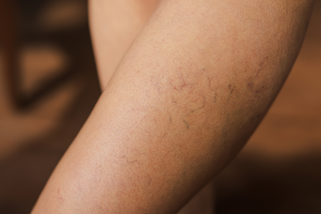 varicose vein treatment on woman's thigh