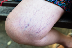 varicose vein treatment